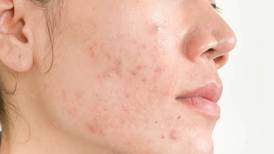 Belleza: 5 hábitos muy comunes que provocan acné