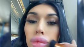 VIDEO | Mujer se inyecta sus labios con relleno por cada decepción amorosa para “sentirse bien” y se hace viral