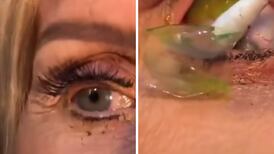 VIDEO| Encuentran 23 lentes de contacto en ojo de una mujer ¡Increíble!