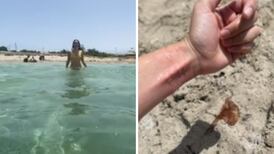VIDEO| Mujer es picada por una medusa y se vuelve viral