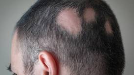 Salud: Aprueban tratamiento para que no se caiga el cabello