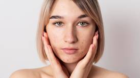 El remedio casero para eliminar acné, espinillas y grasa en la piel