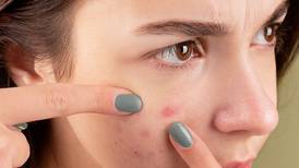 Luce una piel limpia y evita estos tres alimentos que producen acné