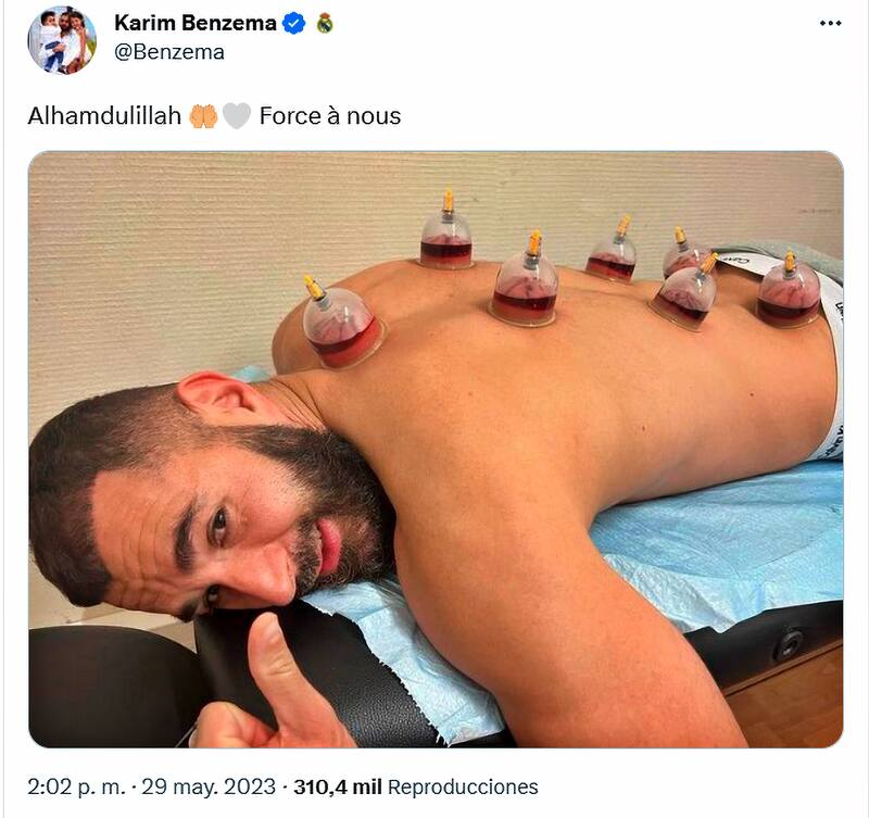 Karim Benzema se hizo una terapia de ventosas, que ayuda a aliviar las tensiones.