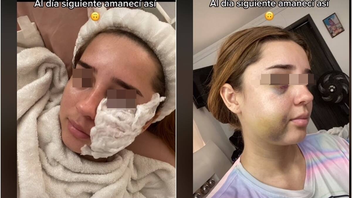 FOTO: ¡Irreconocible! Joven mujer se hace cirugía estética y casi muere