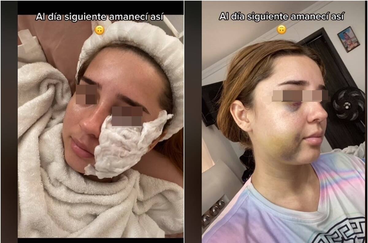 FOTO: ¡Irreconocible! Joven mujer se hace cirugía estética y casi muere