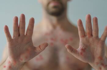 México suma 29 muertes confirmadas por viruela símica ¿Qué es esta enfermedad y cuáles son sus síntomas?