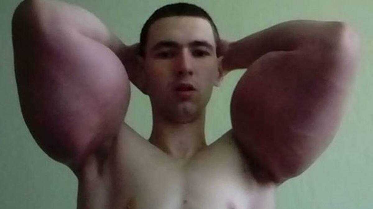 ¿El sucesor de Popeye ? Joven que se inyectó aceite en los brazos necesita una segunda cirugía para evitar amputación