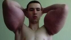 ¿El sucesor de Popeye ? Joven que se inyectó aceite en los brazos necesita una segunda cirugía para evitar amputación