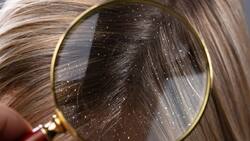 Salud: Estos son los 4 mitos más comunes sobre la caspa ¡No creas todo lo que te dicen!