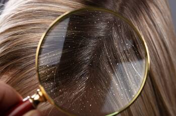 Salud: Estos son los 4 mitos más comunes sobre la caspa ¡No creas todo lo que te dicen!