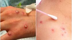 Viruela del mono: ¿Cómo se transmite este virus y cuánto tiempo duran los síntomas?