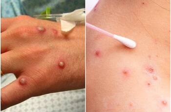 Viruela del mono: ¿Cómo se transmite este virus y cuánto tiempo duran los síntomas?
