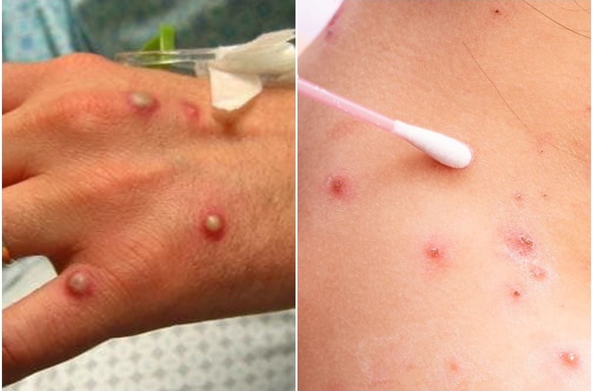 Viruela del mono: ¿Cómo se transmite este virus y cuánto tiempo duran los síntomas?