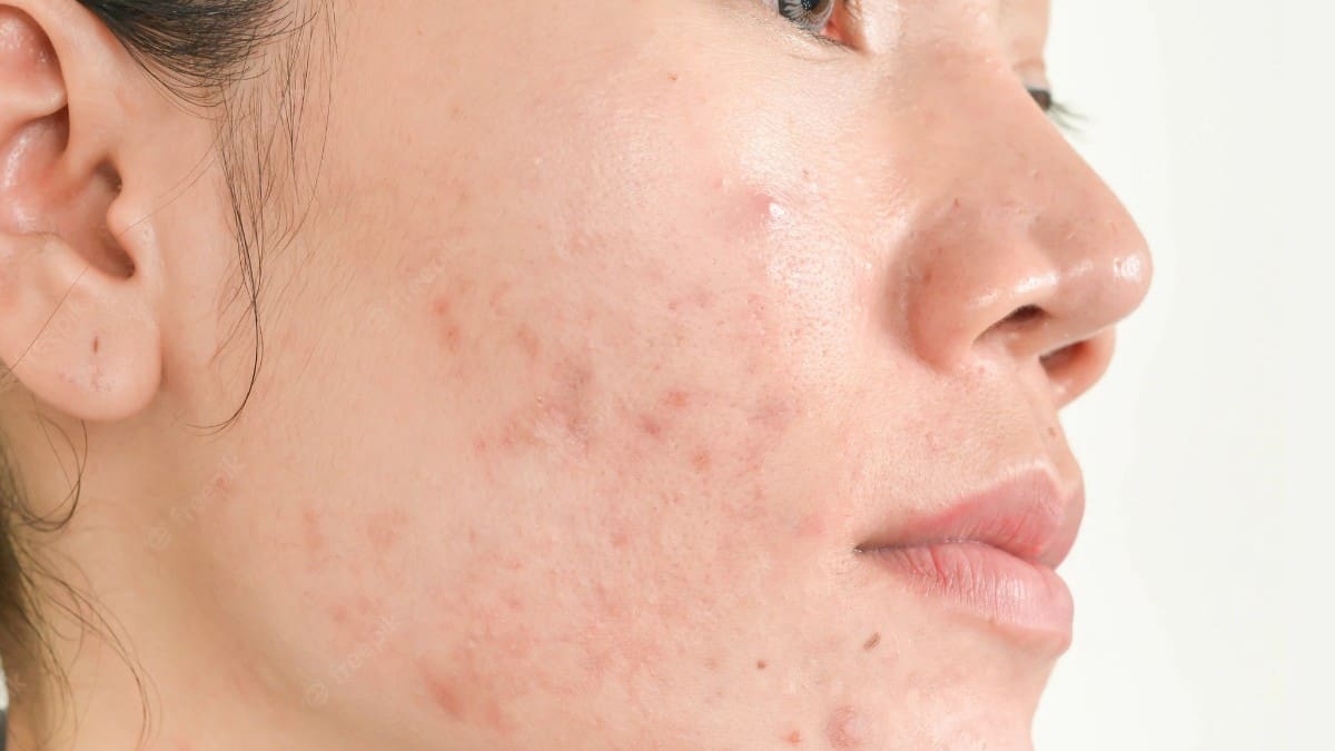 Belleza: 5 hábitos muy comunes que provocan acné