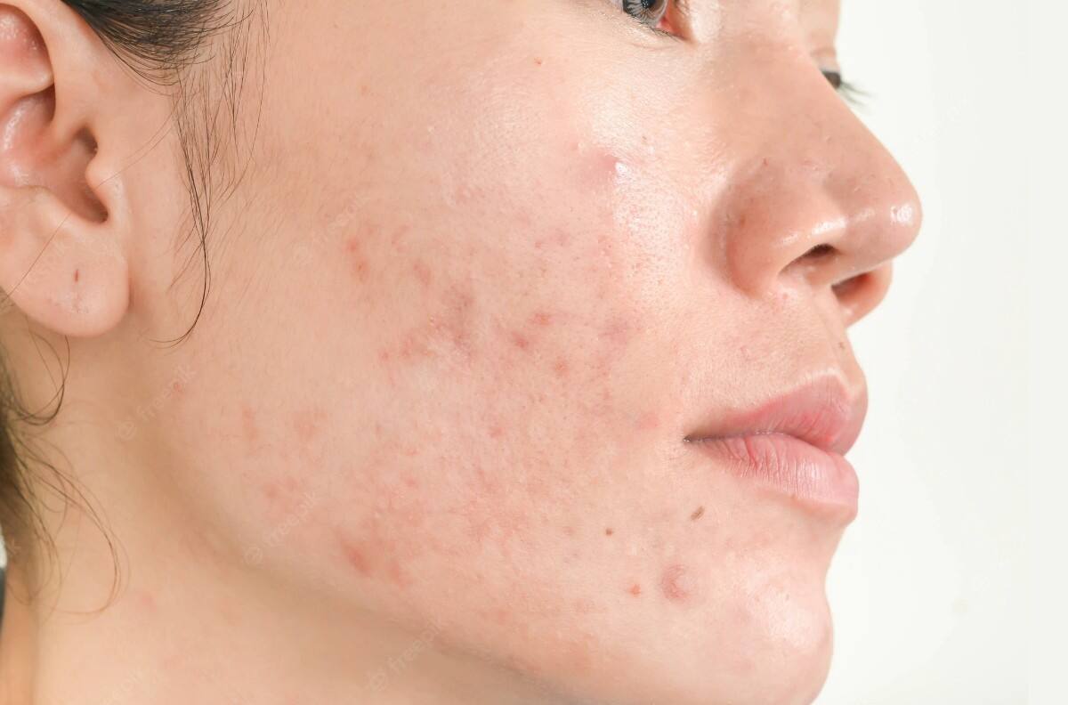 Belleza: 5 hábitos muy comunes que provocan acné