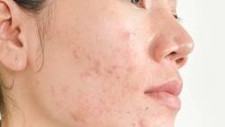 Belleza: 5 hábitos muy comunes que provocan acné