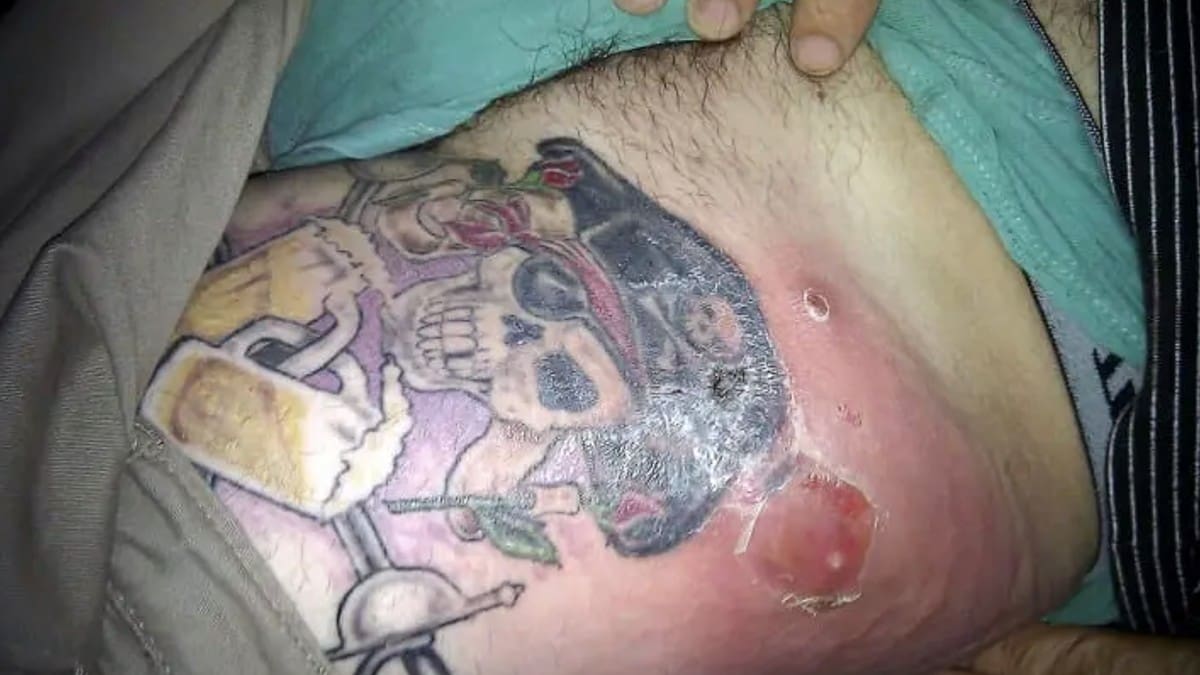 Consejos de salud: ¡Cuidado! Estos son algunos síntomas de un tatuaje infectado