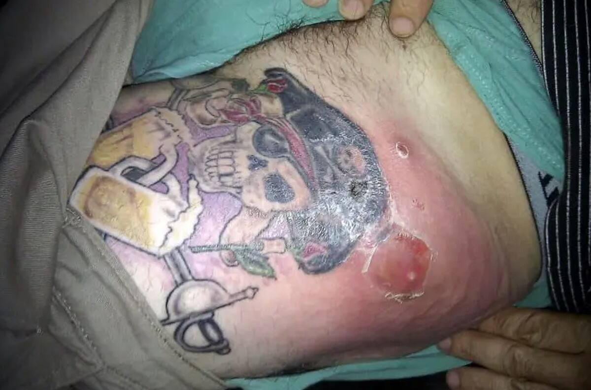 Consejos de salud: ¡Cuidado! Estos son algunos síntomas de un tatuaje infectado