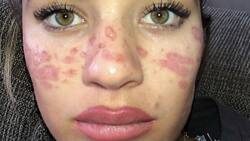 Quemó su rostro y casi pierde la vista al intentar ponerse pecas