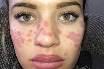 Quemó su rostro y casi pierde la vista al intentar ponerse pecas