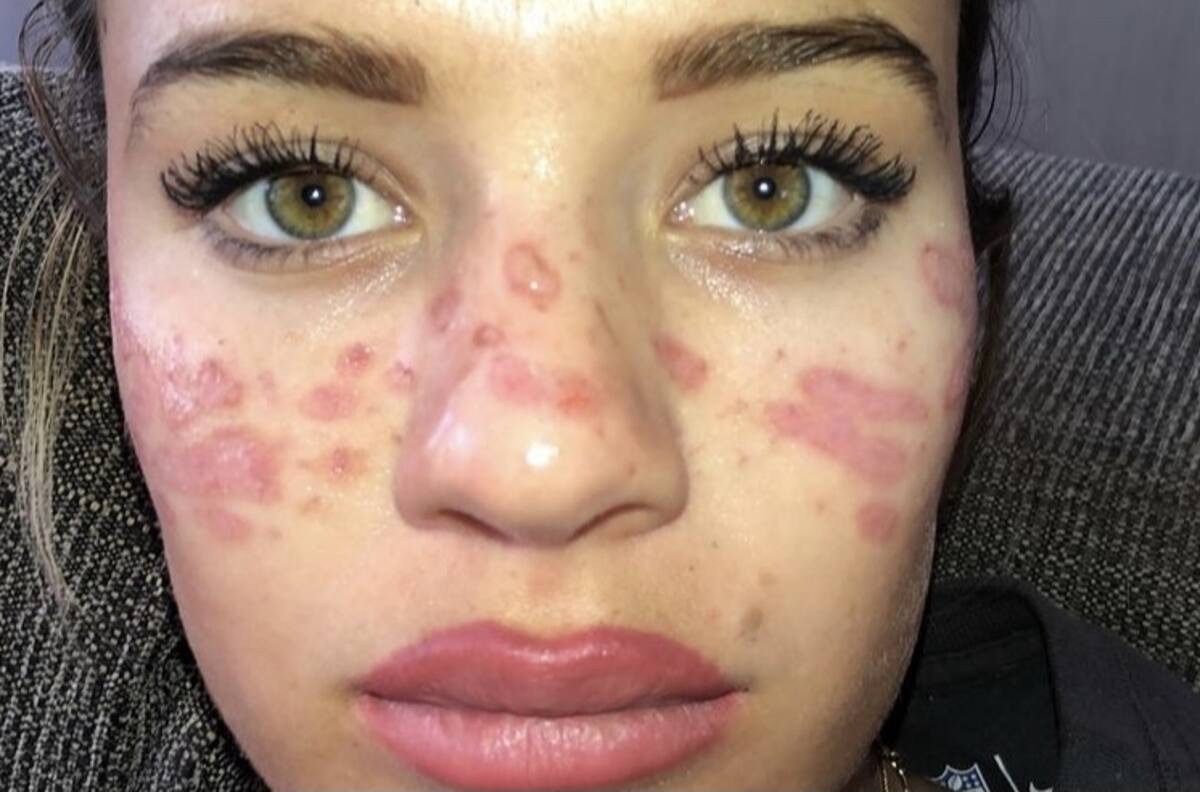 Quemó su rostro y casi pierde la vista al intentar ponerse pecas