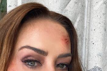 Anette Michel aparece con golpes en el rostro, ¿cómo se los hizo?