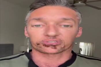 VIDEO | Actor de cine para adultos cuenta su experiencia tras contagiarse de viruela del mono