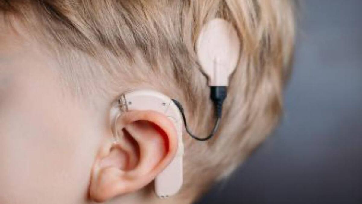 Día del Implante Coclear: Avance médico para oír de por vida ¿Qué es y cómo funciona?