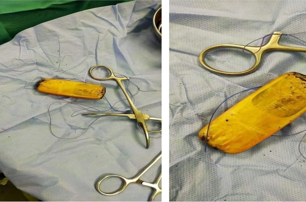 ¡Increíble! Hombre vivió con un celular en el estómago por 6 meses