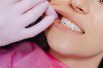 Realiza este remedio casero con aceite de romero para eliminar el sarro dental