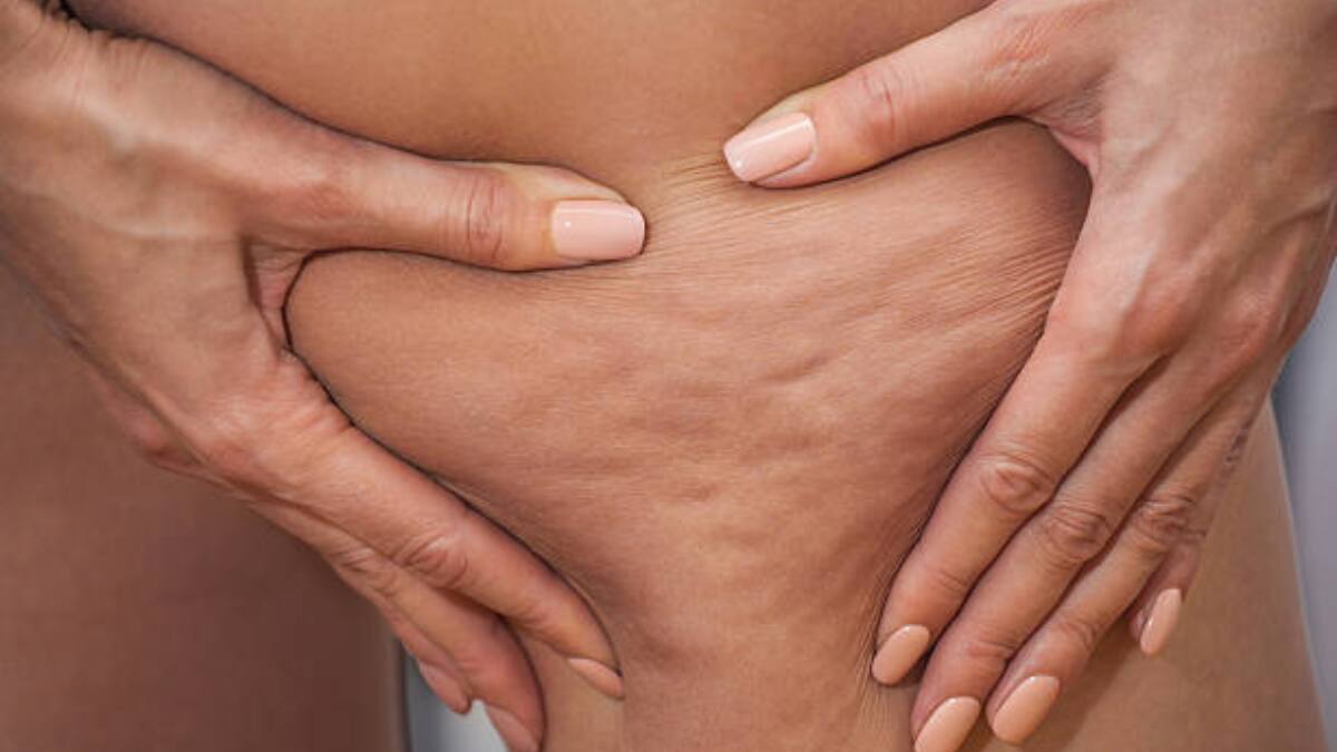 ¡Cuidado! Estos alimentos generan celulitis