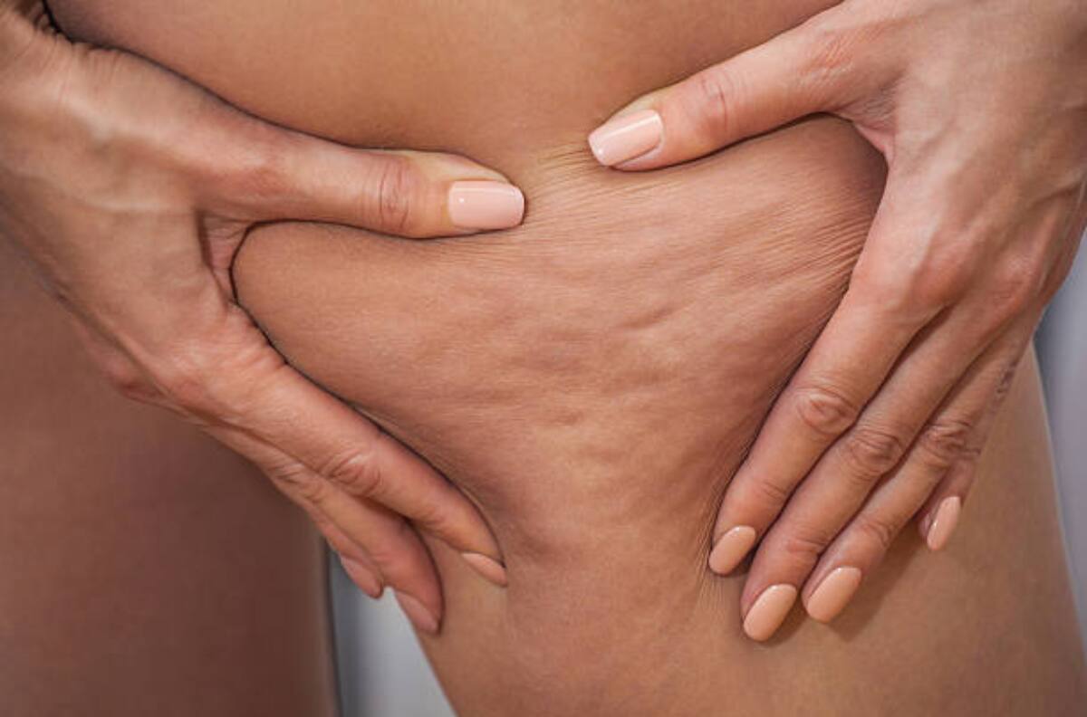 ¡Cuidado! Estos alimentos generan celulitis