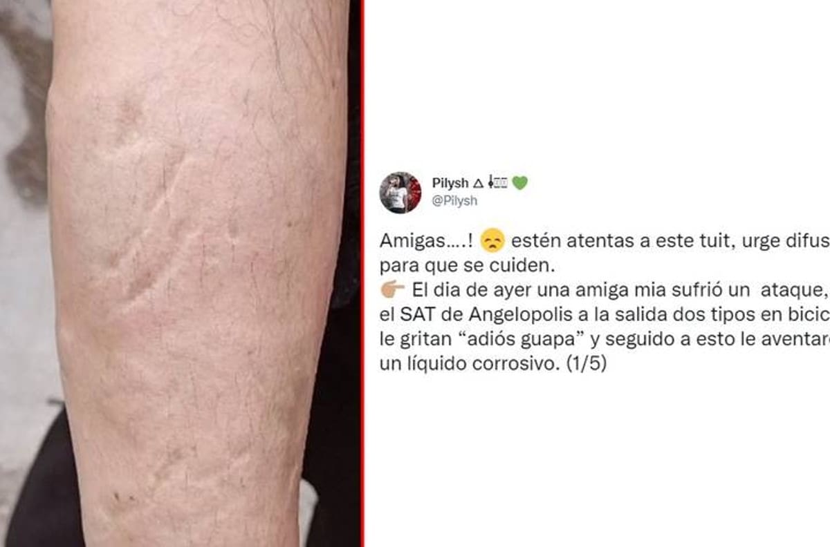 Hombres llaman la atención de mujer y le arrojan ácido en Puebla