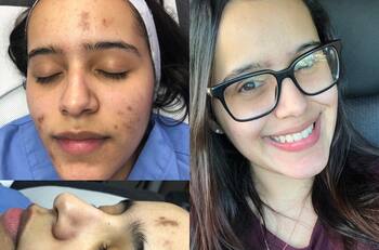 ¿Por qué aparecen manchas en la piel y cómo eliminarlas?