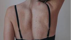 ¿Te salen muchos granitos en el cuerpo? ¡Sigue estos consejos!