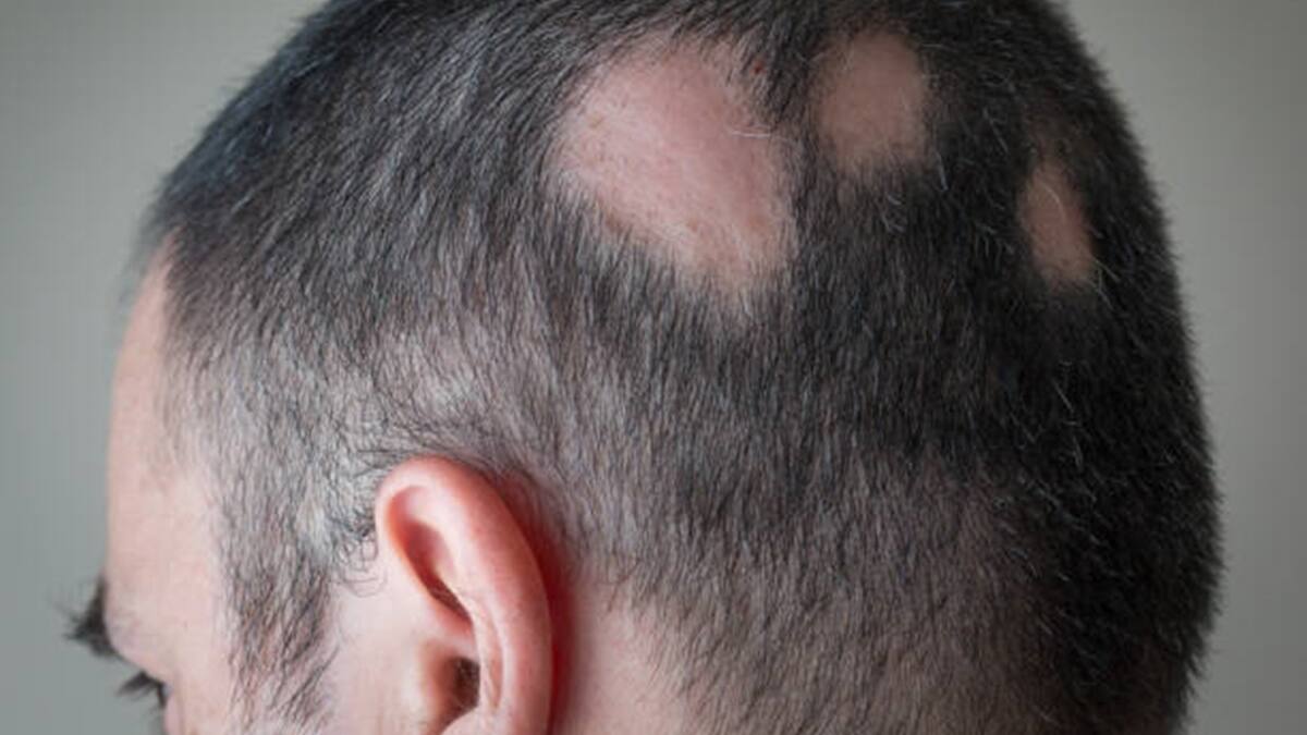 Salud: Aprueban tratamiento para que no se caiga el cabello