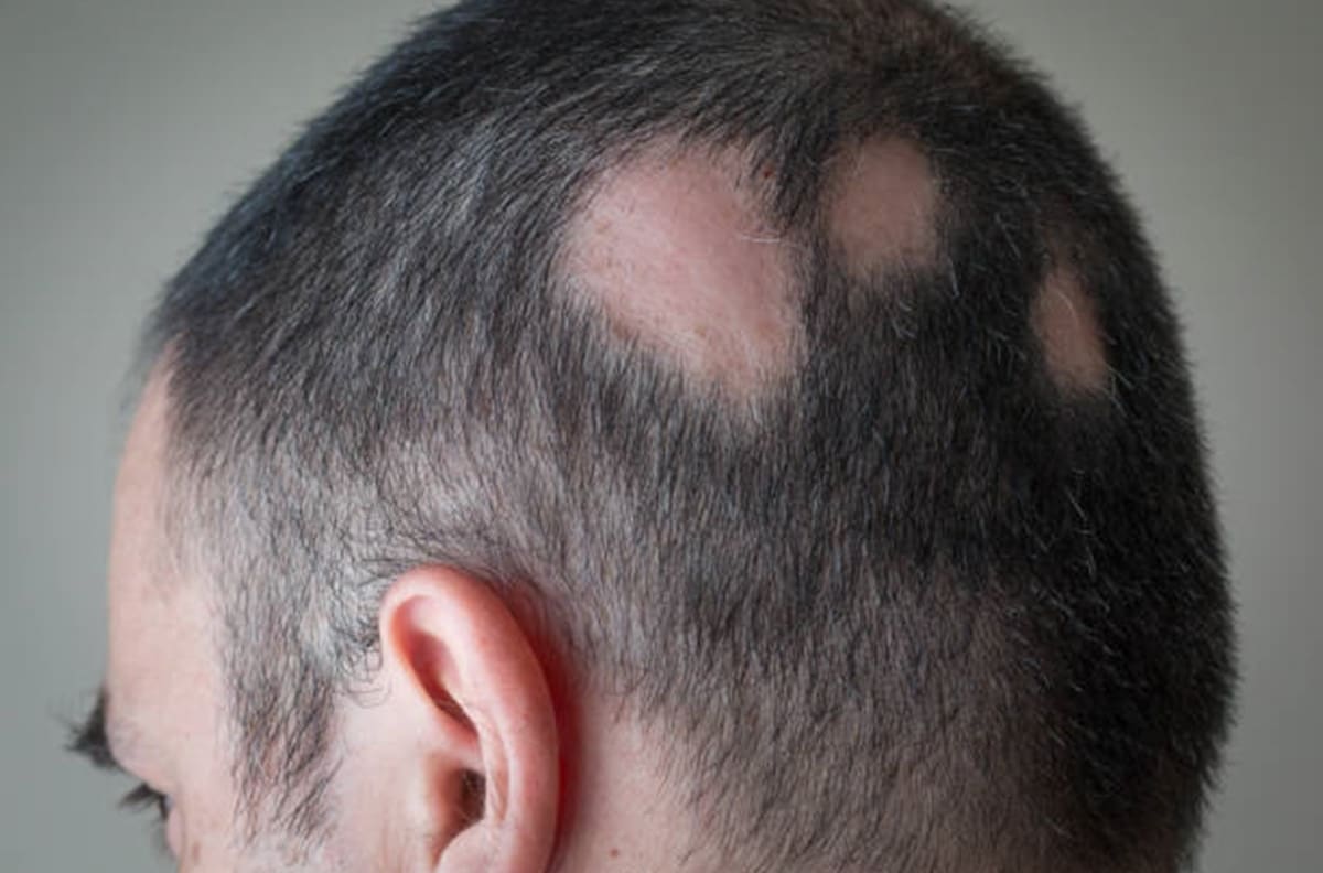 Salud: Aprueban tratamiento para que no se caiga el cabello