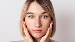 El remedio casero para eliminar acné, espinillas y grasa en la piel