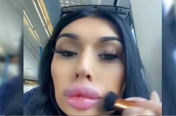 VIDEO | Mujer se inyecta sus labios con relleno por cada decepción amorosa para “sentirse bien” y se hace viral