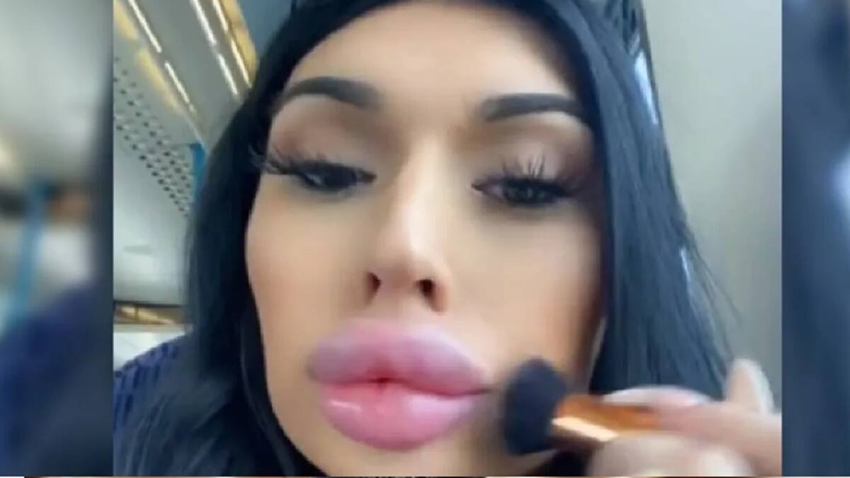 VIDEO | Mujer se inyecta sus labios con relleno por cada decepción amorosa para “sentirse bien” y se hace viral