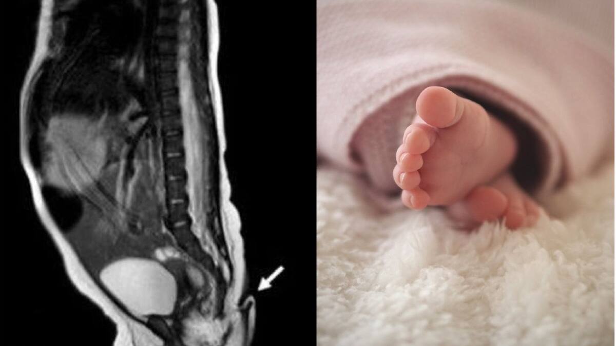 El extraño caso de la bebé que nació con cola de casi 6 cm en México