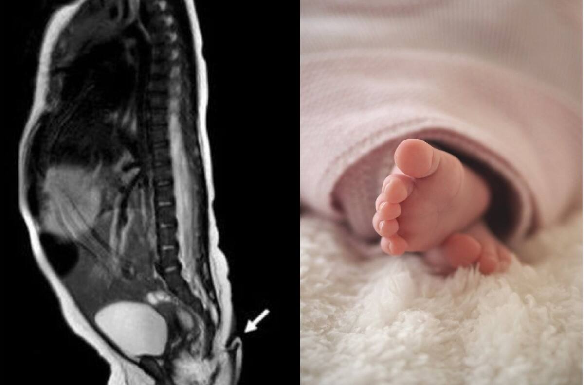 El extraño caso de la bebé que nació con cola de casi 6 cm en México