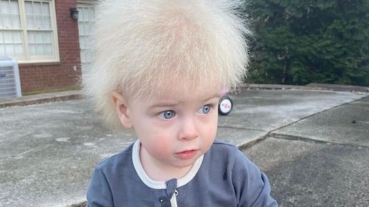 Síndrome del cabello impeinable: Extraño caso de niño estadounidense inunda las redes sociales