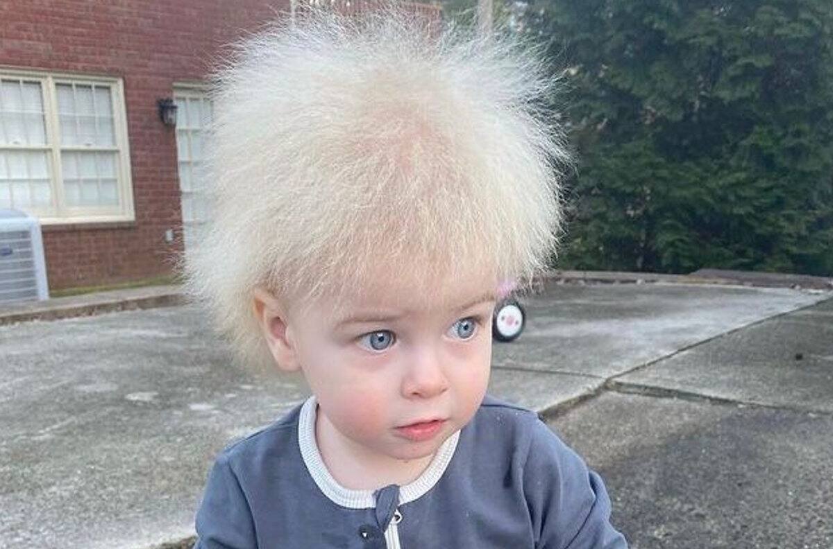 Síndrome del cabello impeinable: Extraño caso de niño estadounidense inunda las redes sociales