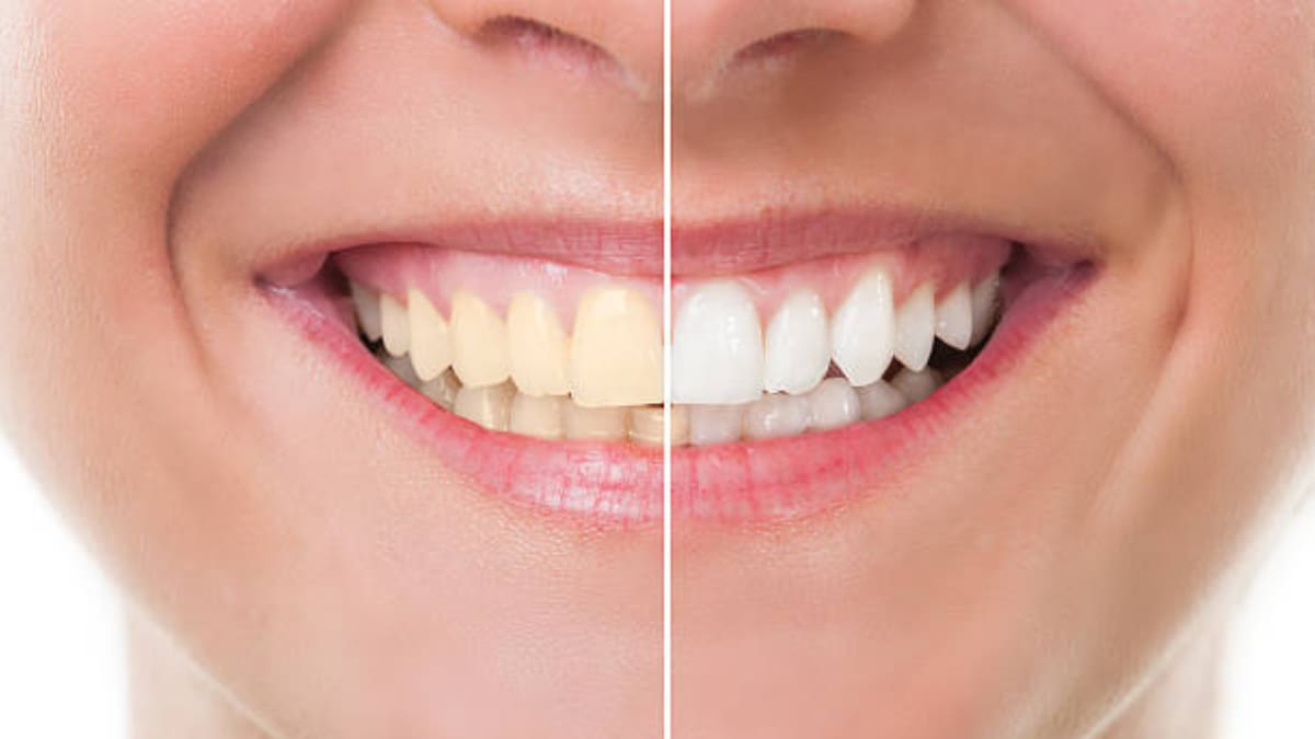 Belleza: Cinco formas de mantener los dientes blancos