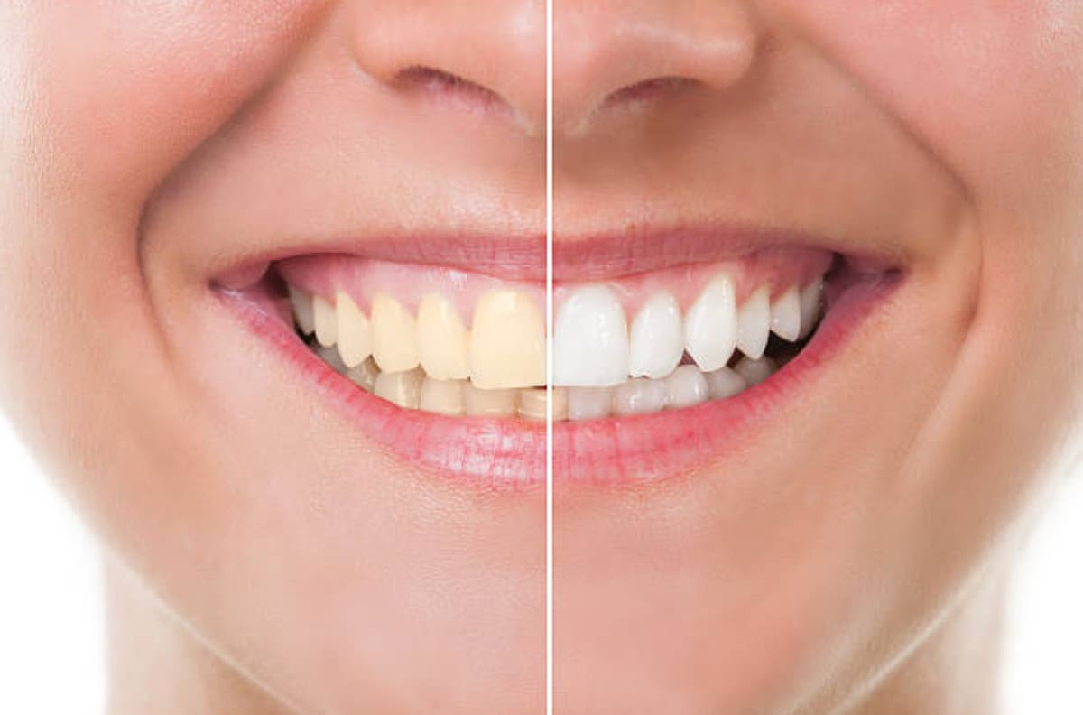 Belleza: Cinco formas de mantener los dientes blancos