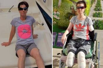 Mujer acude al hospital por dolor de estómago y le amputan las piernas y un brazo