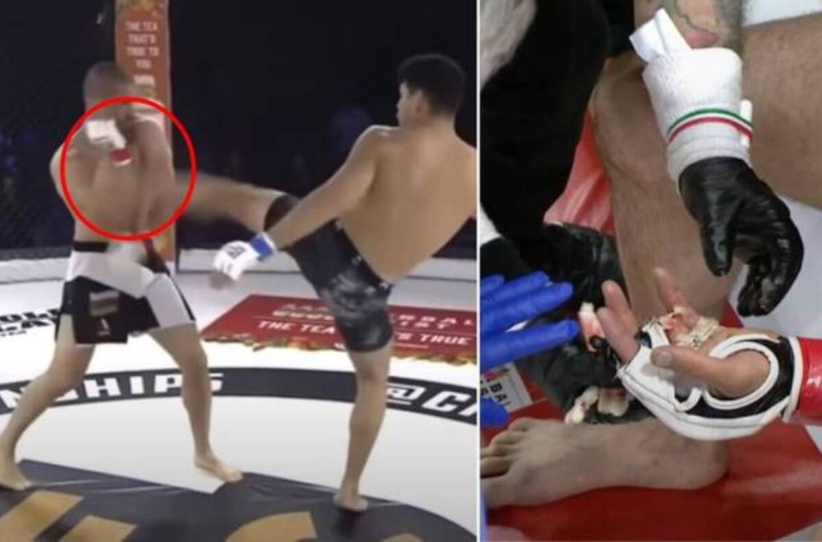 Dramático: Las imágenes del peleador de MMA que perdió un dedo a media pelea