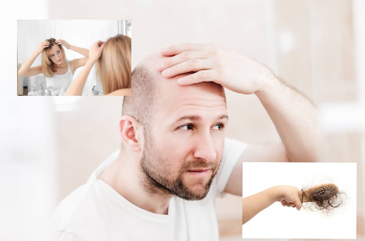 Belleza: Estos son los tres mejores productos para disimular la calvicie